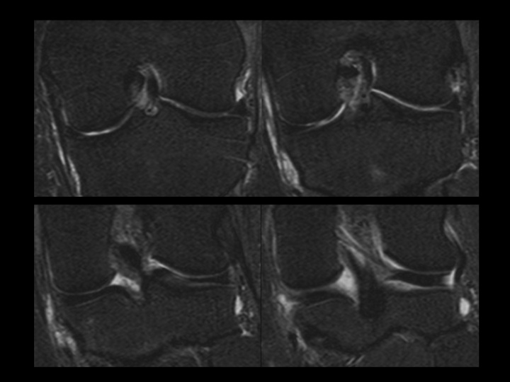 Figure 2 for case posterior root of medial meniscus ( RID2777 )